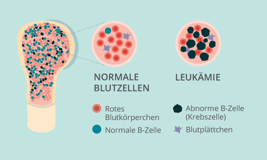 Unterschiede zwischen normalen (Blutzellen) und leukämischen Blutzellen